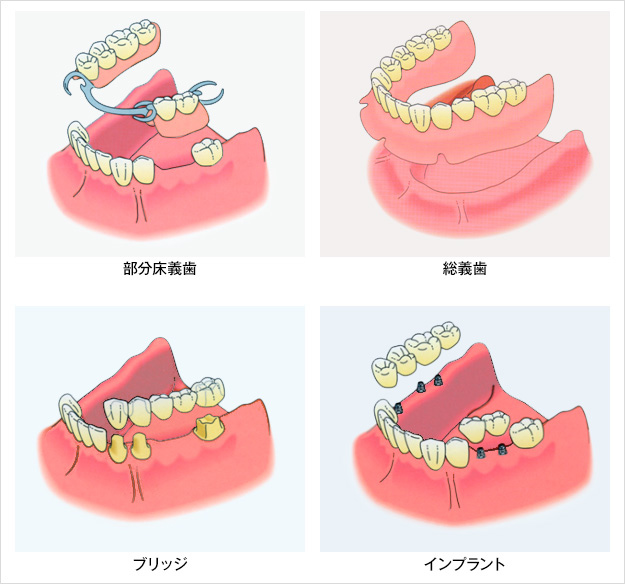 インプラントの利点とは