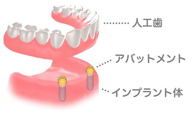 インプラント・オーバーデンチャー
