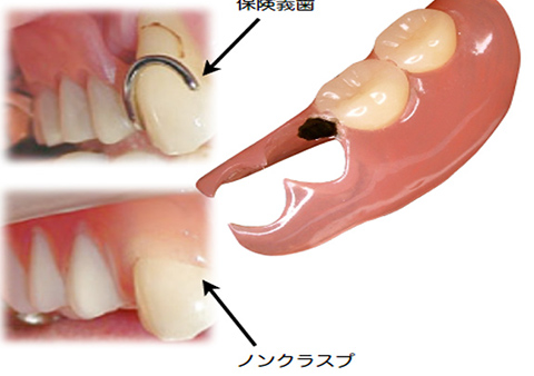 ノンクラスプデンチャー