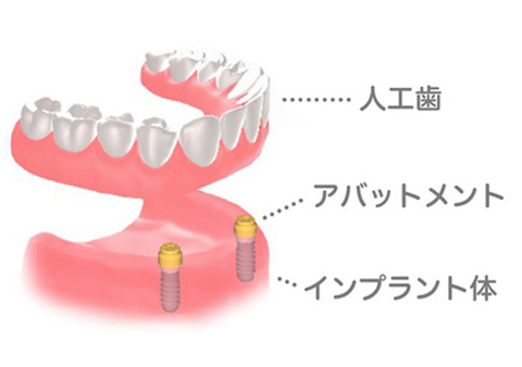 インプラントオーバーデンチャー